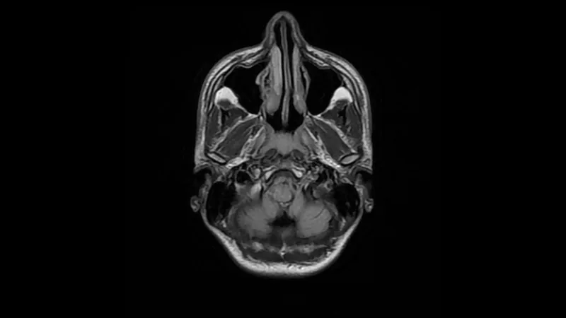 An axial FLAIR MRI image at the level of the skull base, on a black background.
