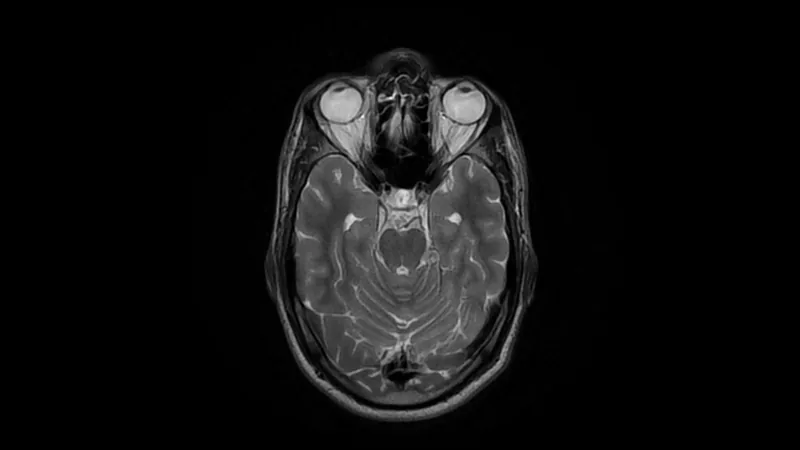 An axial MRI image of a human brain on a black background.