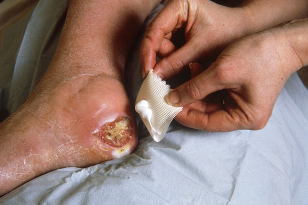 Bedsore pressure ulcer elderly care wound medical negligence nursing home lawyer