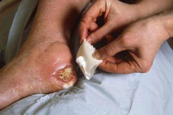 Bedsore pressure ulcer elderly care wound medical negligence nursing home lawyer
